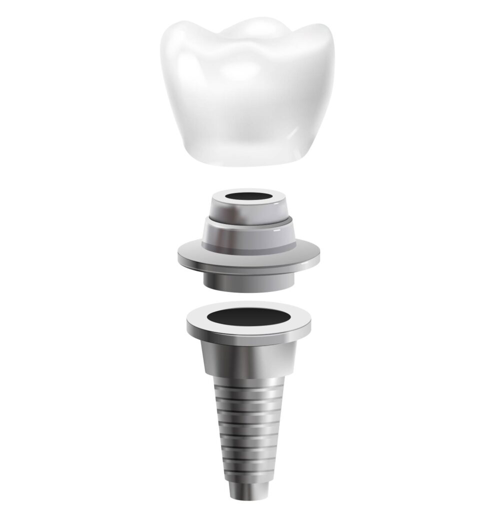 Implante de dente Guaíba - RS